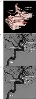 Endovascular treatment of aneurysms of the paraophthalmic segment of the internal carotid artery: Current status